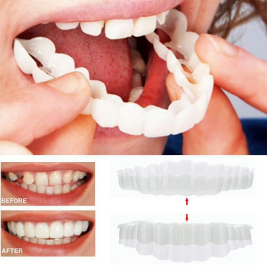 SnapOn Smile Dental Veneer