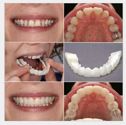 SnapOn Smile Dental Veneer