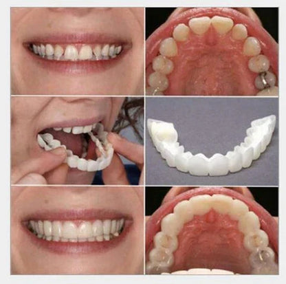 SnapOn Smile Dental Veneer